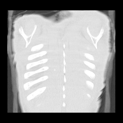 Accessory left horizontal fissure with lingular pneumonia (Radiopaedia 53763-59843 Coronal lung window 42).jpg