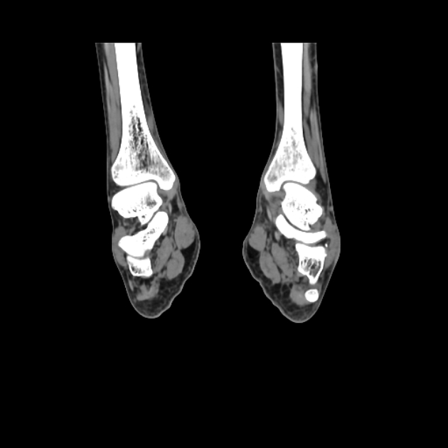 Accessory soleus muscle (Radiopaedia 61069-68943 Coronal non-contrast 40).jpg