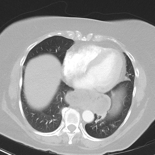 File:Achalasia (Radiopaedia 47147-51685 Axial lung window 34).png