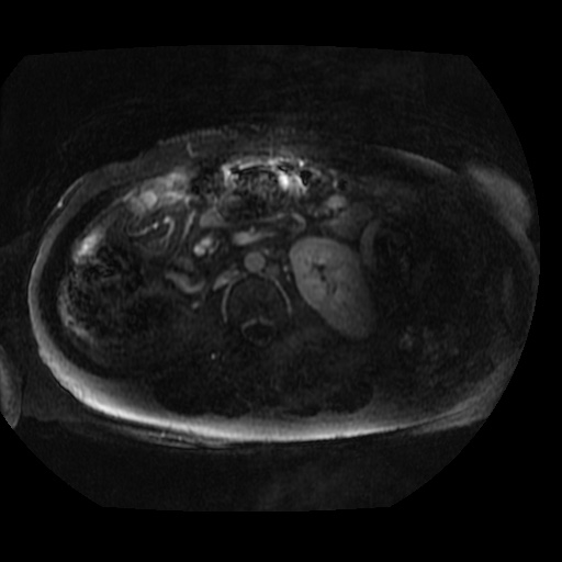 Acinar cell carcinoma of the pancreas (Radiopaedia 75442-86668 Axial T1 C+ fat sat 7).jpg