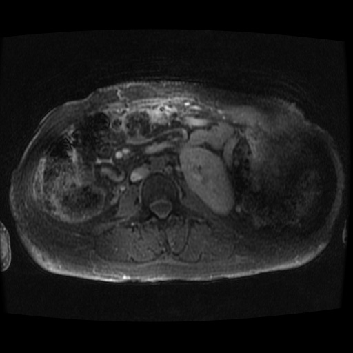 Acinar cell carcinoma of the pancreas (Radiopaedia 75442-86668 Axial late phase (~30 mins) 8).jpg