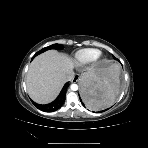 Acinar cell carcinoma of the pancreas (Radiopaedia 75442-86669 Axial C+ portal venous phase 15).jpg
