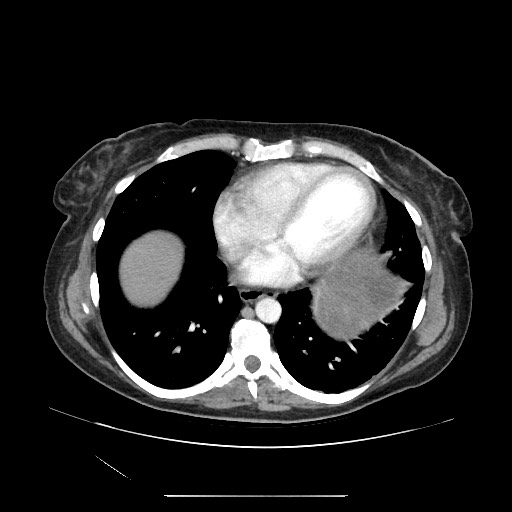 File:Acinar cell carcinoma of the pancreas (Radiopaedia 75442-86669 Axial C+ portal venous phase 5).jpg