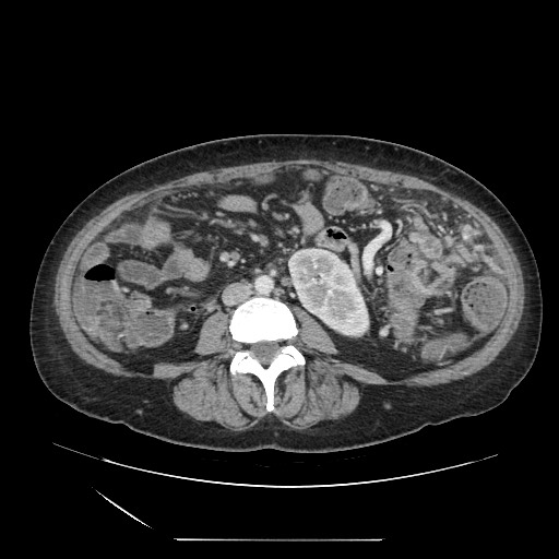 Acinar cell carcinoma of the pancreas (Radiopaedia 75442-86669 Axial C+ portal venous phase 81).jpg