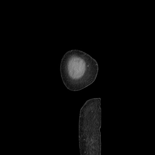 Acinar cell carcinoma of the pancreas (Radiopaedia 75442-86669 Sagittal C+ portal venous phase 193).jpg