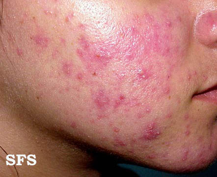 File:Acne Rosacea (Dermatology Atlas 5).jpg