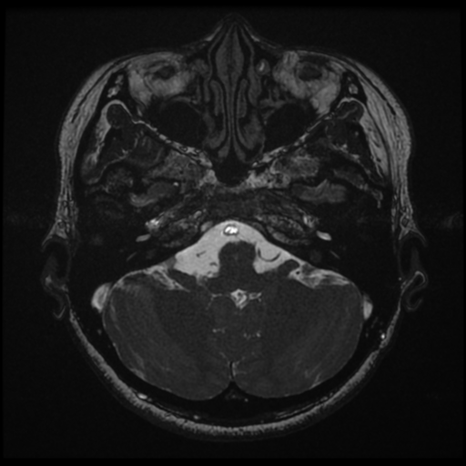 File:Acoustic neuroma (Radiopaedia 34049-35283 Axial 40).png