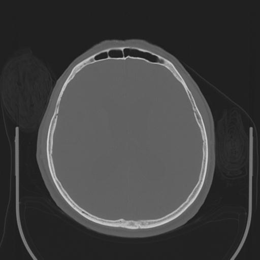 File:Acoustic schwannoma (Radiopaedia 29488-29982 AXIAL BONE THICK non-contrast 29).jpg