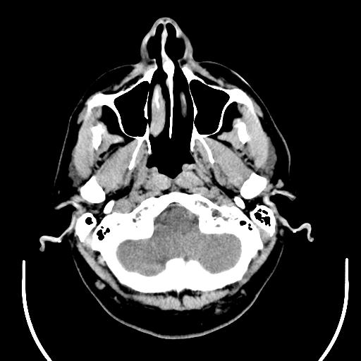 File:Acoustic schwannoma (Radiopaedia 29488-29982 AXIAL THICK non-contrast 5).jpg