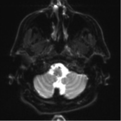 File:Acoustic schwannoma (Radiopaedia 55729-62281 E 1).png