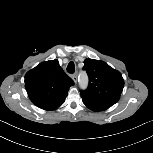 File:Acquired tracheoesophageal fistula (Radiopaedia 57747-65042 Axial C+ portal venous phase 22).jpg