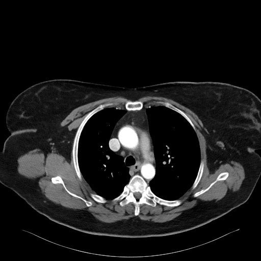 Acromioclavicular joint cyst (Radiopaedia 58455-65610 Axial C+ arterial phase 44).jpg