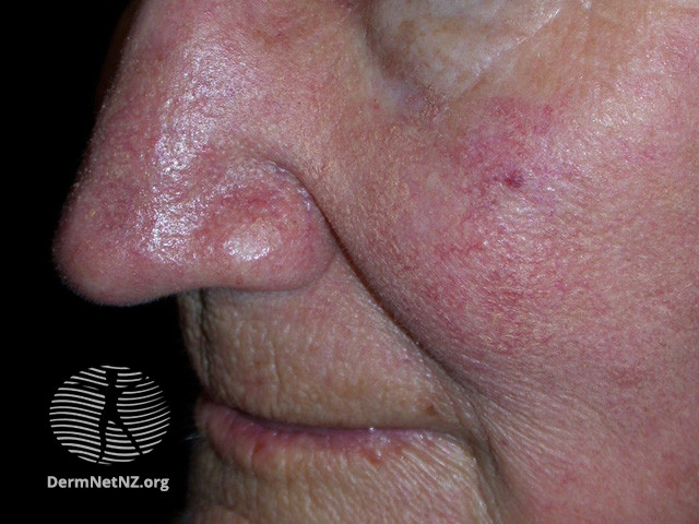 Actinic Keratoses treated with imiquimod (DermNet NZ lesions-ak-imiquimod-3743).jpg