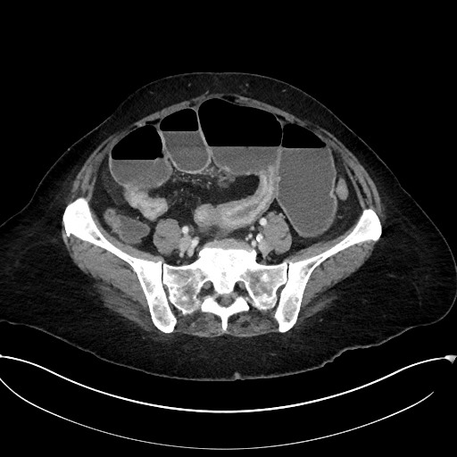 Active Crohn disease (Radiopaedia 59394-66750 Axial C+ portal venous phase 52).jpg