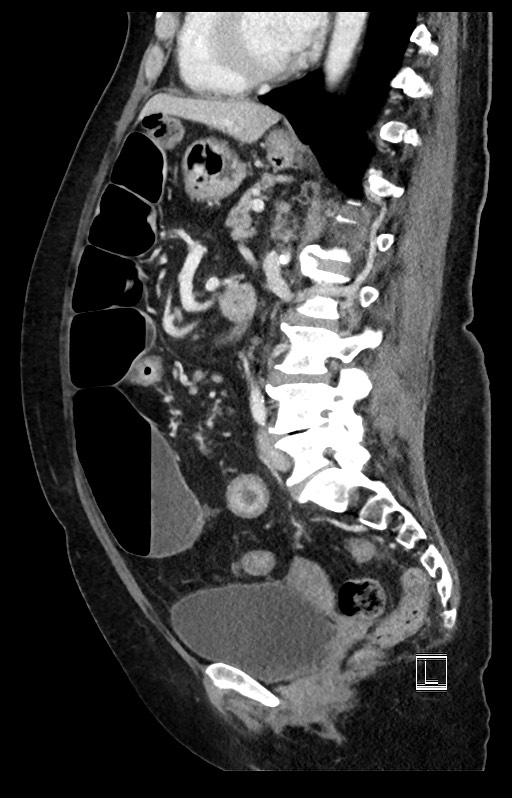 Active Crohn disease (Radiopaedia 59394-66750 Sagittal C+ portal venous phase 25).jpg
