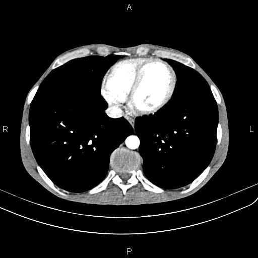 Active crohn disease (Radiopaedia 87133-103397 Axial C+ arterial phase 6).jpg
