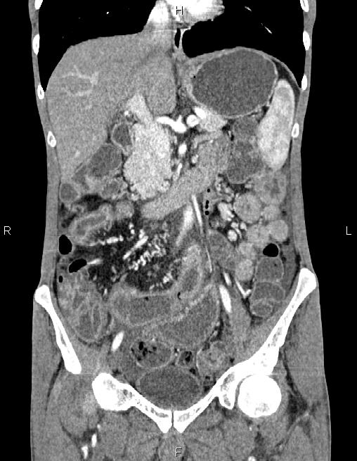 Active crohn disease (Radiopaedia 87133-103397 Coronal C+ arterial phase 28).jpg