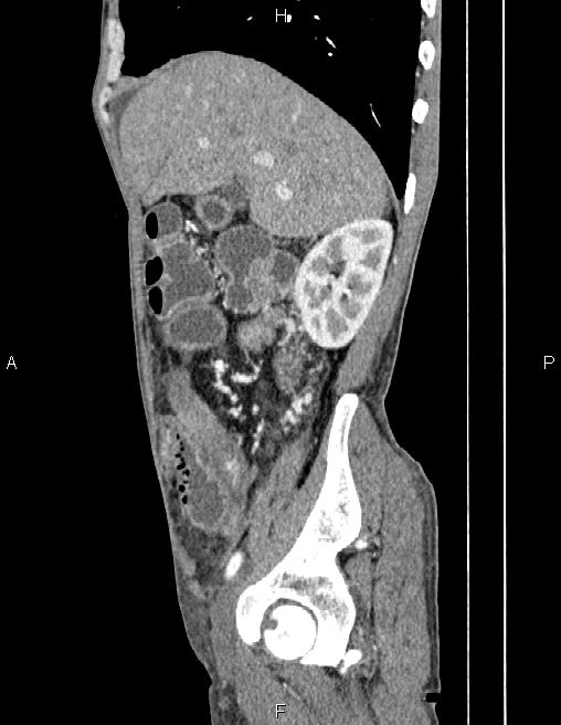 Active crohn disease (Radiopaedia 87133-103397 Sagittal C+ arterial phase 23).jpg