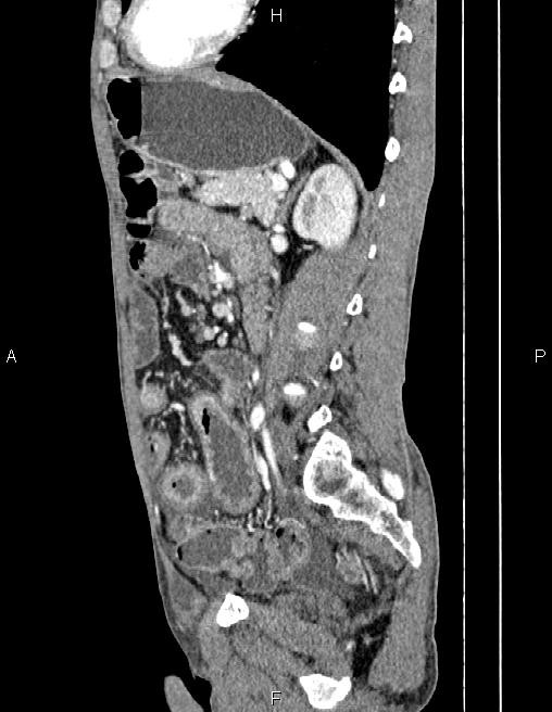 Active crohn disease (Radiopaedia 87133-103397 Sagittal C+ arterial phase 57).jpg