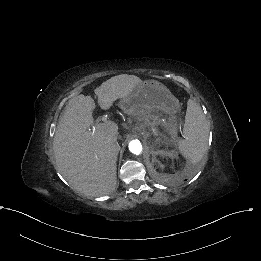 File:Active renal extravasation with large subcapsular and retroperitoneal hemorrhage (Radiopaedia 60975-68796 Axial C+ arterial phase 48).jpg
