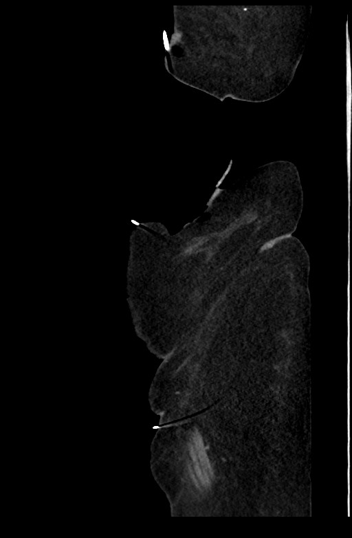 Active renal extravasation with large subcapsular and retroperitoneal hemorrhage (Radiopaedia 60975-68796 Sagittal C+ portal venous phase 26).jpg