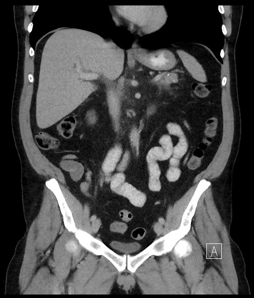 Acute-on-chronic pancreatitis (Radiopaedia 67286-76656 Coronal C+ portal venous phase 40).jpg