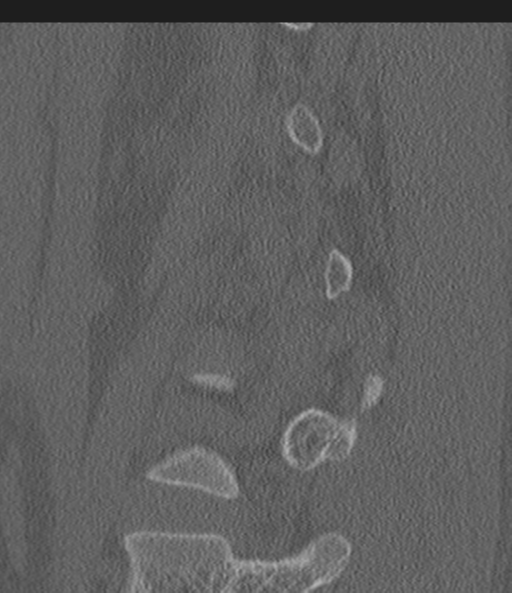 Acute L1 burst compression fracture (Radiopaedia 34430-35755 Sagittal bone window 49).png