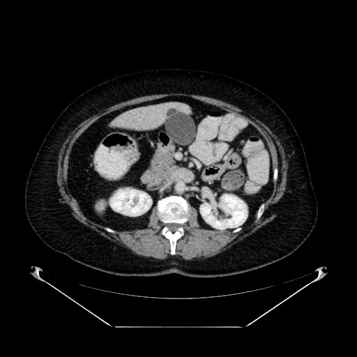Acute appendicitis, heterotaxy syndrome (Radiopaedia 66884-76202 Axial C+ portal venous phase 49).jpg