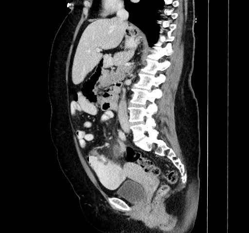 Acute appendicitis, heterotaxy syndrome (Radiopaedia 66884-76202 Sagittal C+ portal venous phase 64).jpg