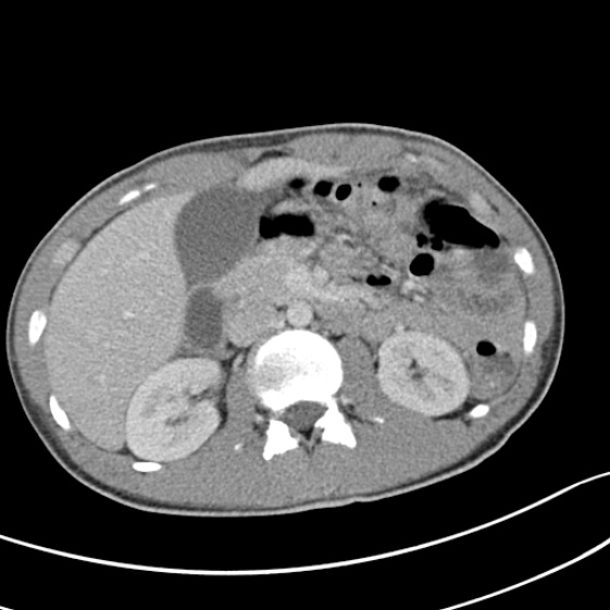 Acute appendicitis (Radiopaedia 32614-33572 Axial C+ portal venous phase 24).jpg