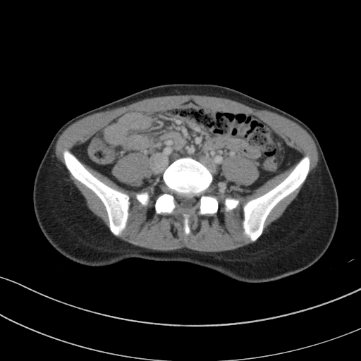 File:Acute appendicitis (Radiopaedia 62608-70901 Axial C+ portal venous phase 4).jpg