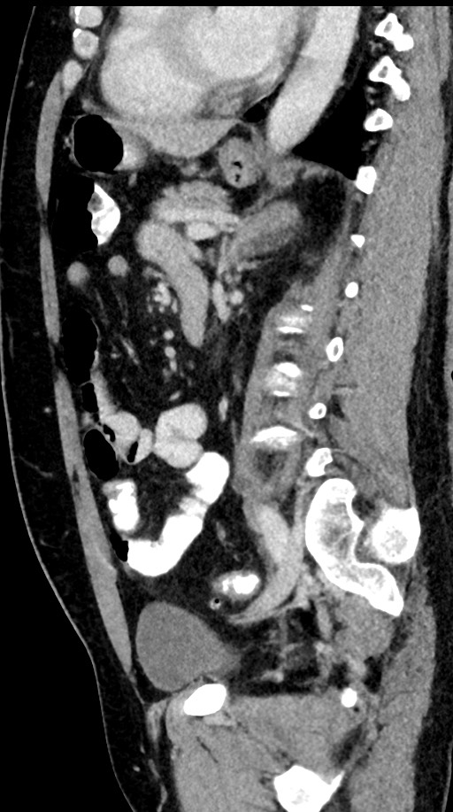 Acute appendicitis (Radiopaedia 77016-88960 Sagittal C+ portal venous phase 47).jpg