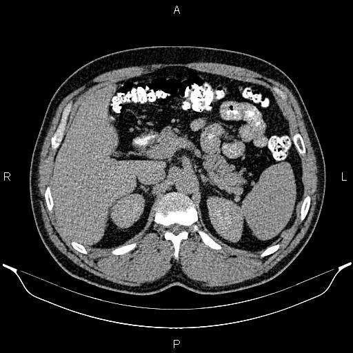 File:Acute appendicitis (Radiopaedia 84780-100240 Axial C+ delayed 30).jpg