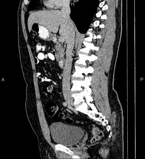 File:Acute appendicitis (Radiopaedia 84780-100240 Sagittal C+ portal venous phase 46).jpg