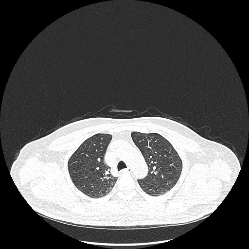 Acute appendicitis and COVID 19 pneumonia (Radiopaedia 76604-88380 Axial lung window 17).jpg