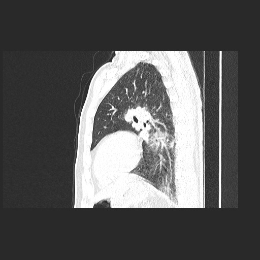 Acute appendicitis and COVID 19 pneumonia (Radiopaedia 76604-88380 Sagittal lung window 64).jpg