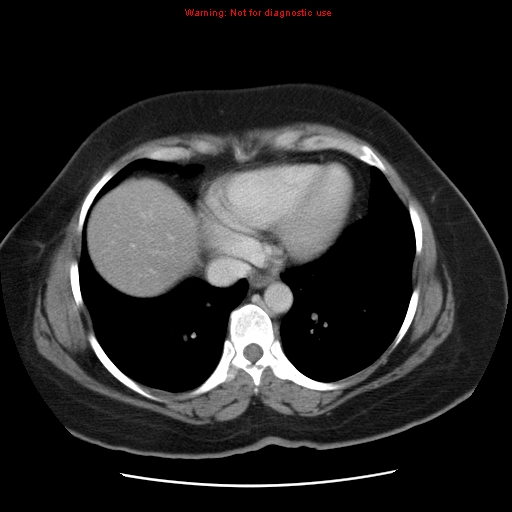 Acute appendicitis complicated by ovarian vein thrombophlebitis (Radiopaedia 16172-15851 Axial C+ portal venous phase 14).jpg