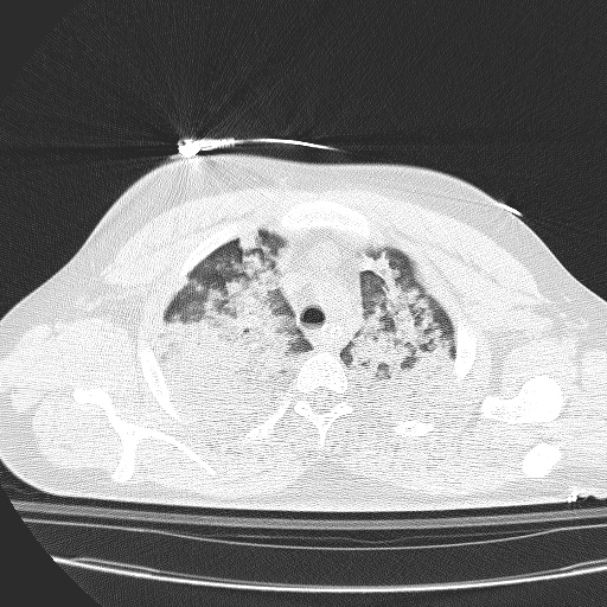 Acute aspiration pneumonitis (Radiopaedia 33605-34703 Axial lung window 26).jpg