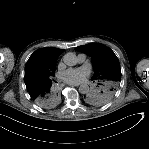 Acute aspiration pneumonitis (Radiopaedia 55642-62166 Axial liver window 35).jpg