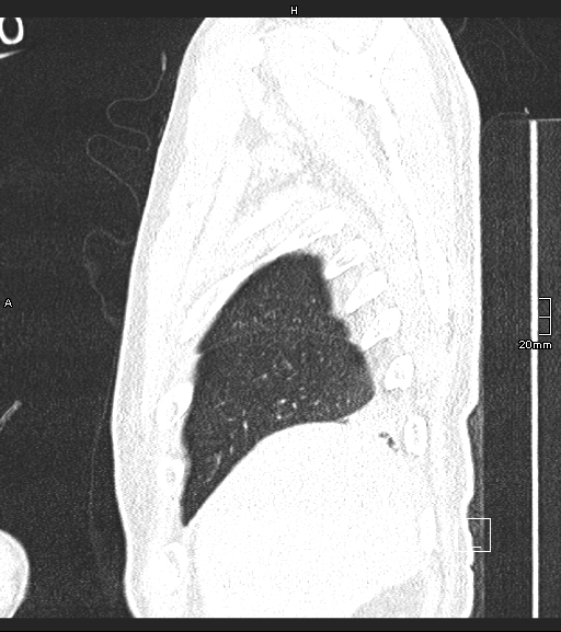 Acute aspiration pneumonitis (Radiopaedia 55642-62166 Sagittal lung window 139).jpg