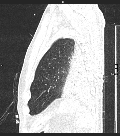 Acute aspiration pneumonitis (Radiopaedia 55642-62166 Sagittal lung window 16).jpg