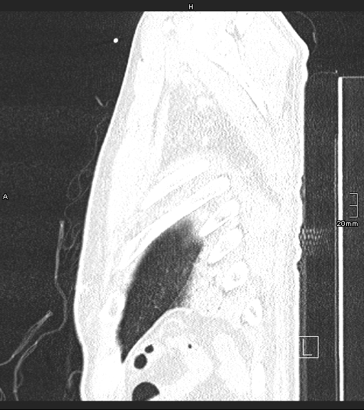 File:Acute aspiration pneumonitis (Radiopaedia 55642-62166 Sagittal lung window 4).jpg