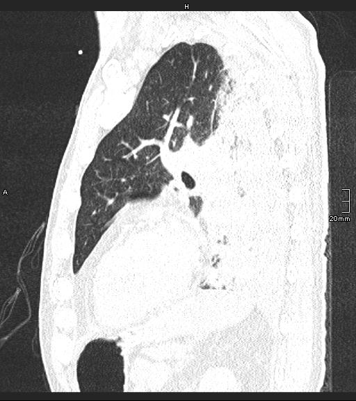 File:Acute aspiration pneumonitis (Radiopaedia 55642-62166 Sagittal lung window 47).jpg