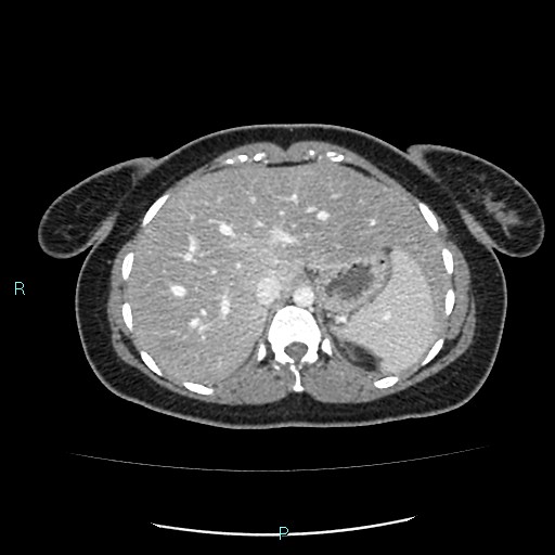 File:Acute bilateral pyelonephritis (Radiopaedia 37146-38881 Axial C+ portal venous phase 20).jpg