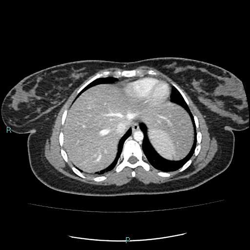 Acute bilateral pyelonephritis (Radiopaedia 37146-38881 Axial C+ portal venous phase 7).jpg