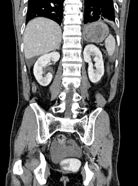 Acute bowel ischemia (Radiopaedia 87695-104114 Coronal C+ portal venous phase 275).jpg