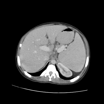 File:Acute calculous cholecystitis in patient with osteopetrosis (Radiopaedia 77871-90159 Axial C+ portal venous phase 27).jpg