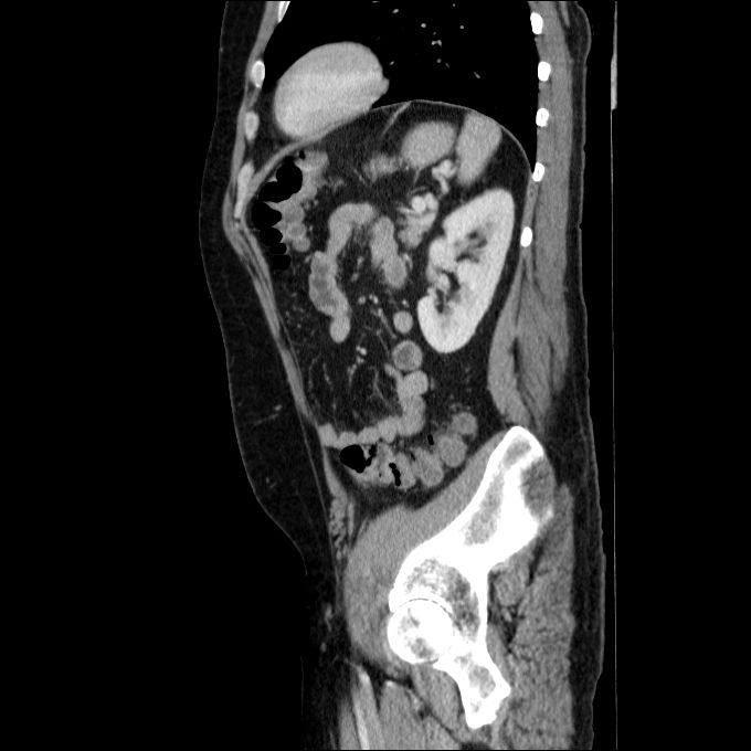Acute cholecystitis and incidental left sided IVC (Radiopaedia 49352-54459 Sagittal C+ portal venous phase 29).jpg