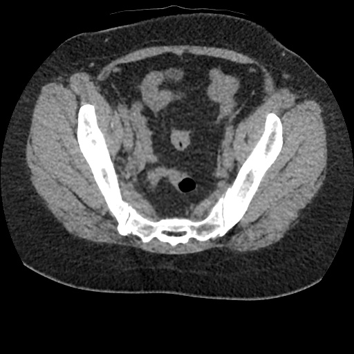 File:Acute cholecystitis and ureteric colic (Radiopaedia 42330-45444 Axial prone 90).jpg