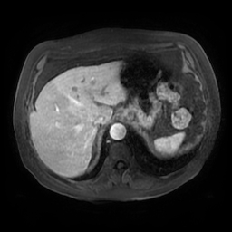 Acute cholecystitis complicated by pylephlebitis (Radiopaedia 65782-74915 Axial arterioportal phase T1 C+ fat sat 26).jpg